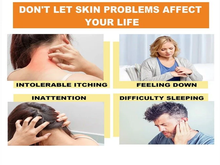 South Moon - Bee Venom Psoriasis Care Cream (Original)