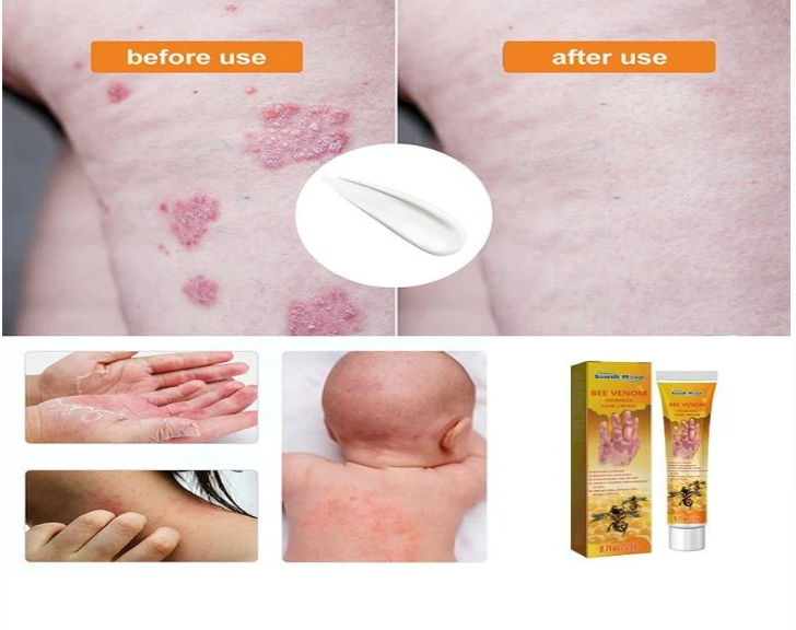 South Moon - Bee Venom Psoriasis Care Cream (Original)