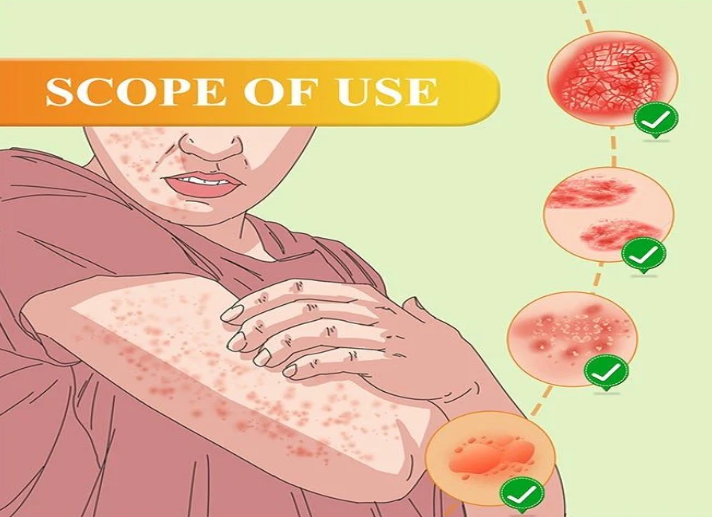 South Moon - Bee Venom Psoriasis Care Cream (Original)