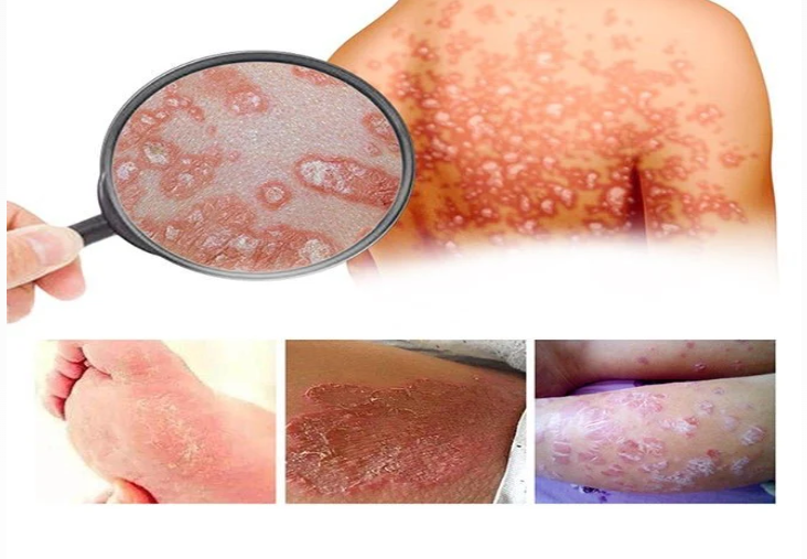 South Moon - Bee Venom Psoriasis Care Cream (Original)