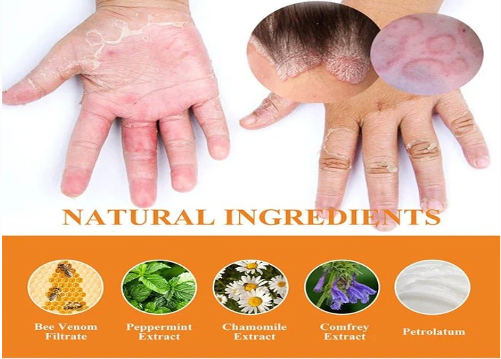 South Moon - Bee Venom Psoriasis Care Cream (Original)