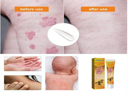 South Moon - Bee Venom Psoriasis Care Cream (Original)