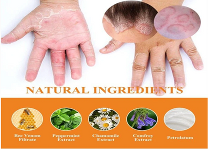 South Moon - Bee Venom Psoriasis Care Cream (Original)